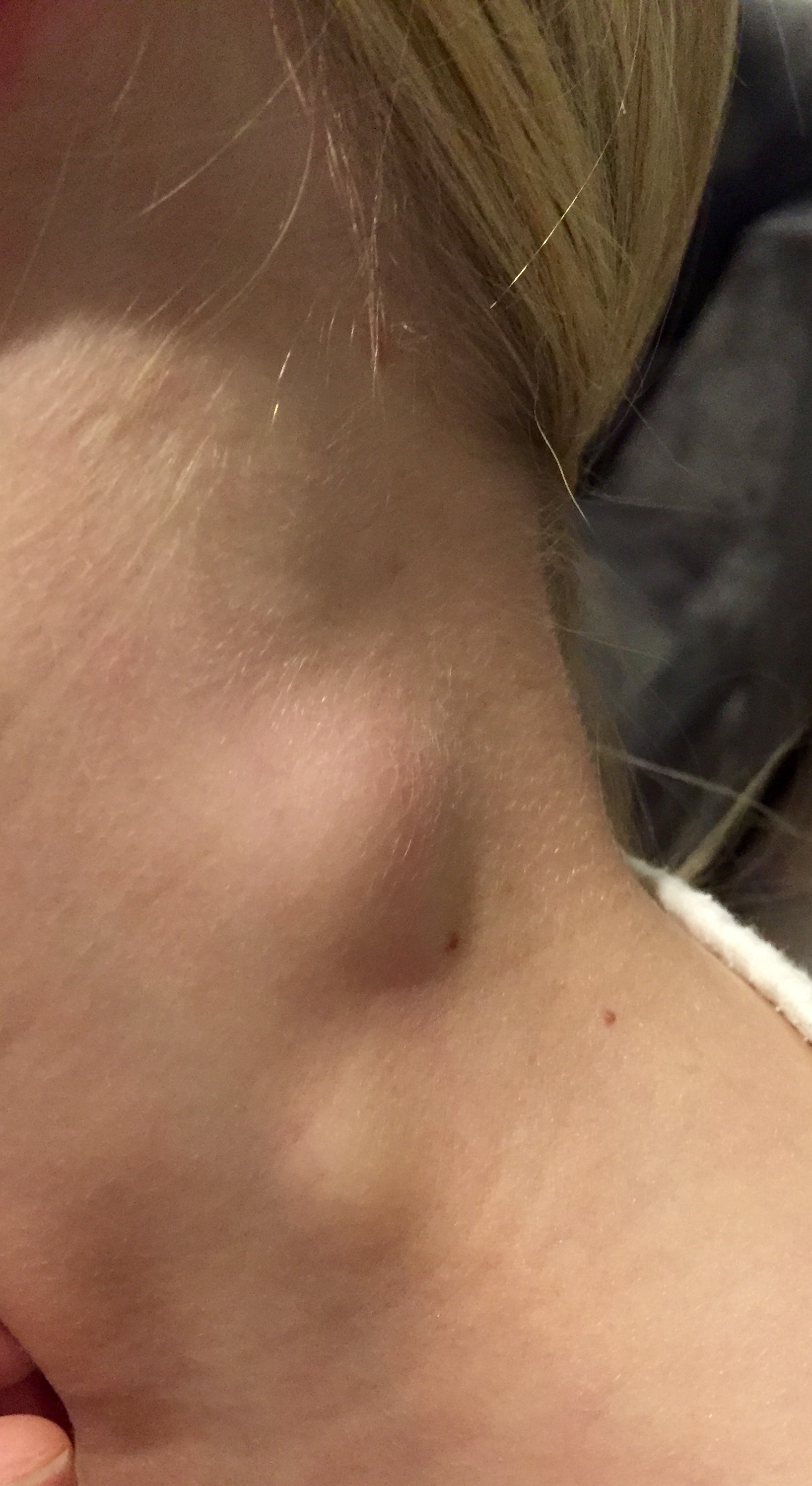 swollen lymph node back of neck child